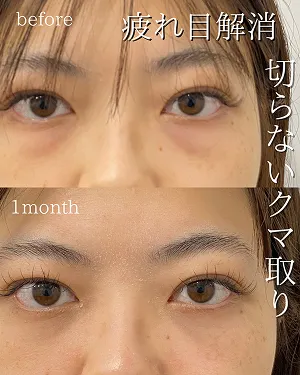 疲れ目解消 切らないクマ取り