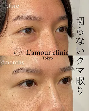切らないクマ取り