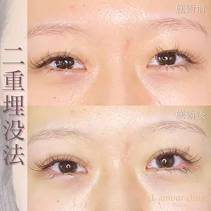 二重埋没法