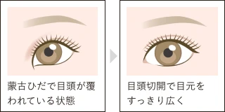 二重ラインが引き立ち、理想のデザインが目指しやすく