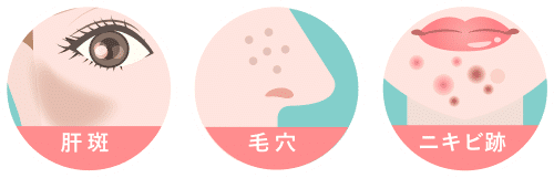肝斑・毛穴・ニキビ跡