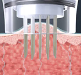 安定した状態で、非常に細い針が一定の深さに刺入される