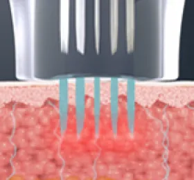 表面塗布では浸透しにくい成分も、肌の深層までアプローチしやすくなることが期待でき、薬剤の浸透効率を高めた施術設計が特徴※
