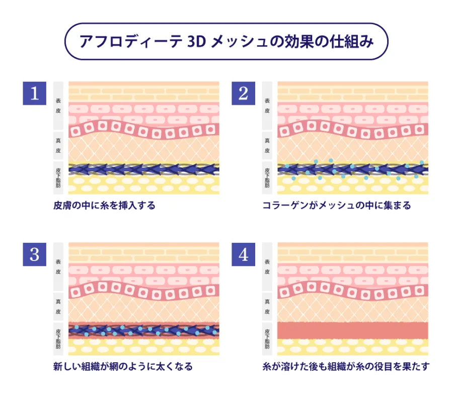 アフロディーテ3Dメッシュの効果の仕組み