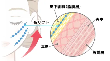 フェイスリフト効果