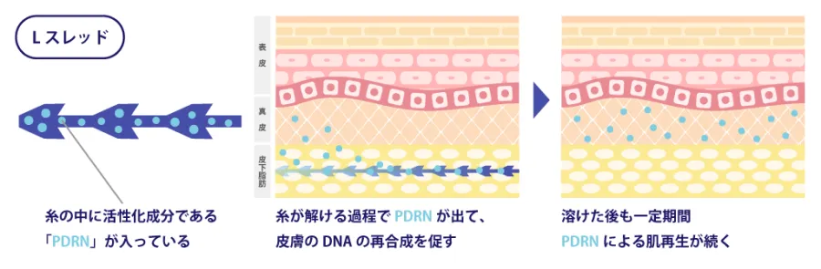 Lスレッドの効果の仕組み