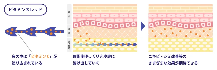 ビタミンスレッドの効果の仕組み