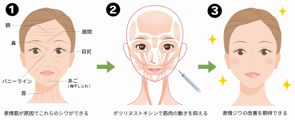 香月えくぼ ほうれい線付近のえくぼ｜原因や突然できた時の治療方法も紹介！ | L'amour clinic Tokyo（ラムールクリニック東京）渋谷院