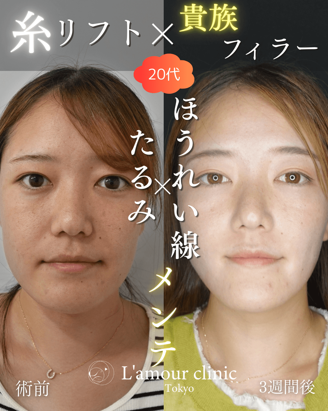 糸リフト×貴族フィラーの症例①