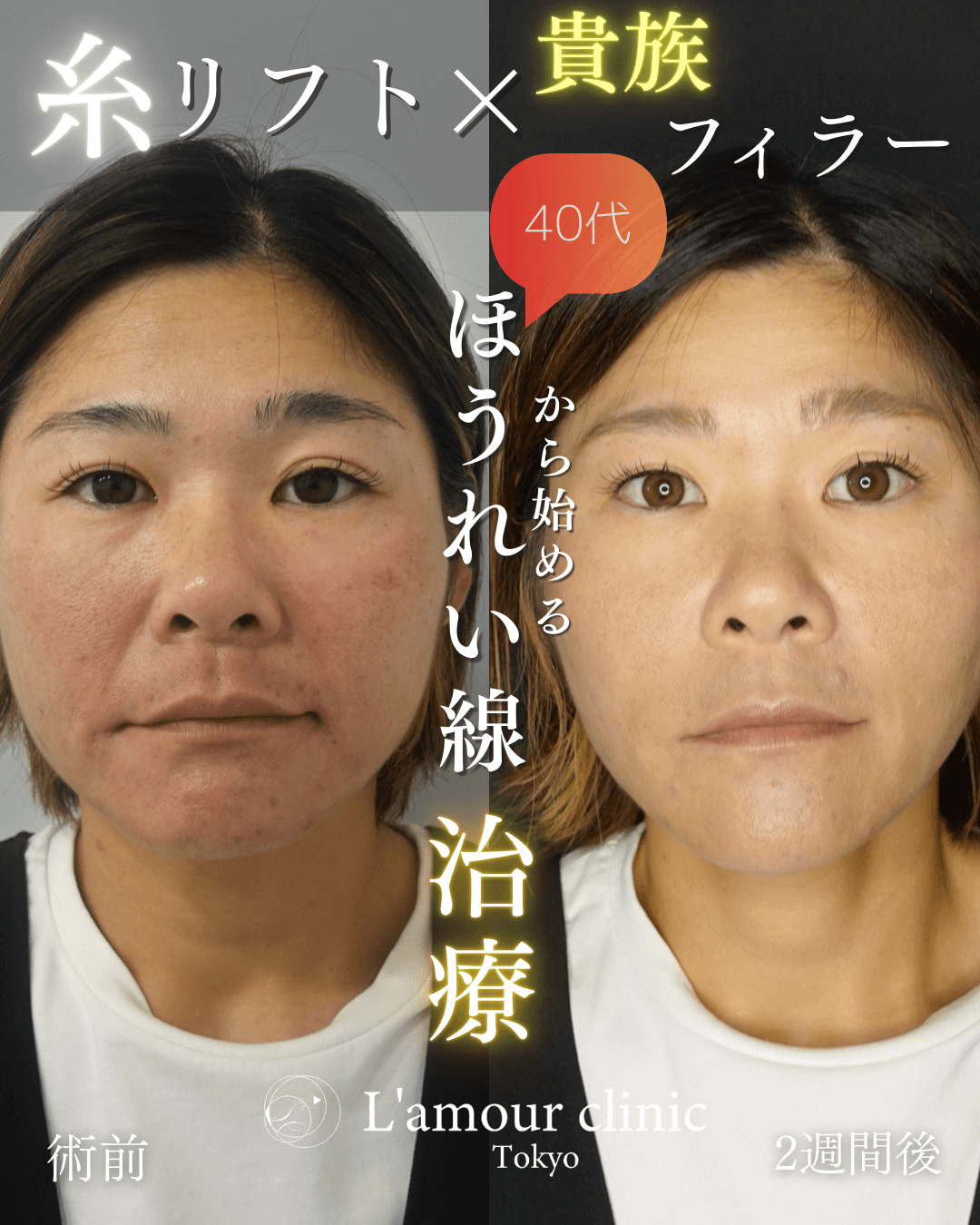 糸リフト×貴族フィラーの症例②