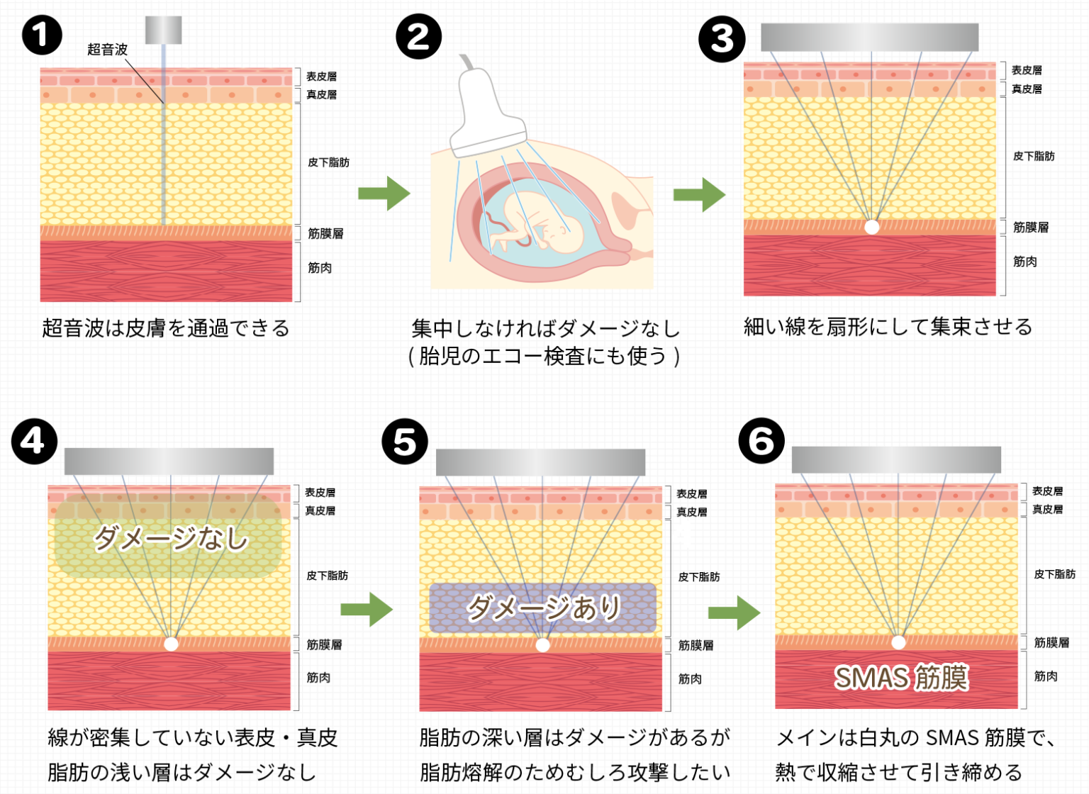 ハイフ（HIFU）