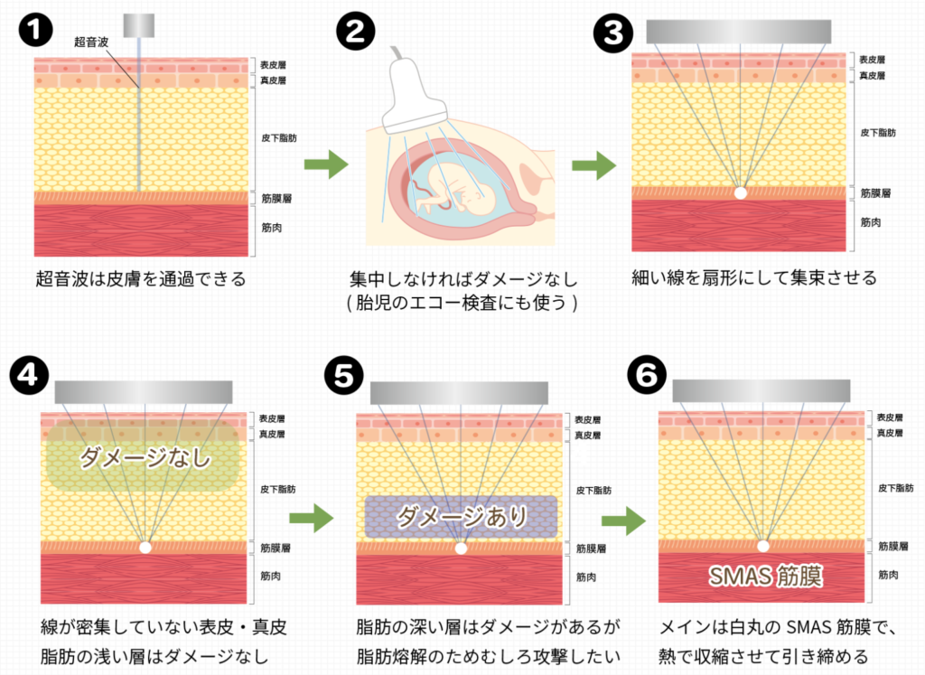 ハイフの仕組み