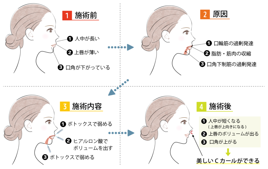 Cカールリップ