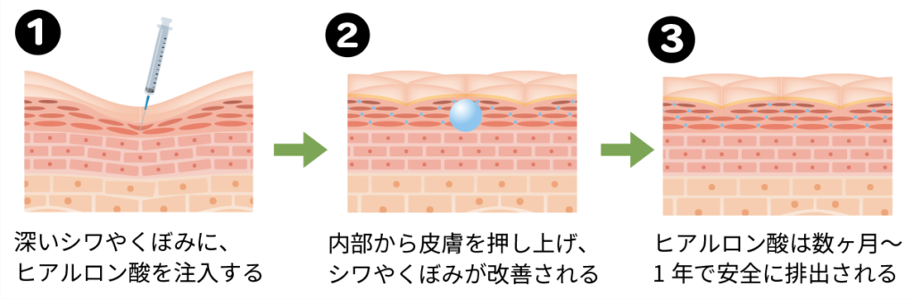 ヒアルロン酸注射