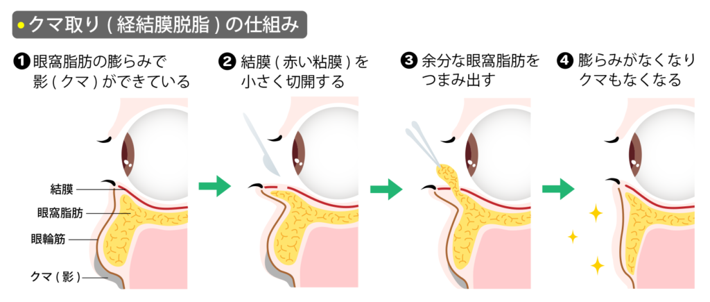 クマ取り（経結膜脱脂）の仕組み