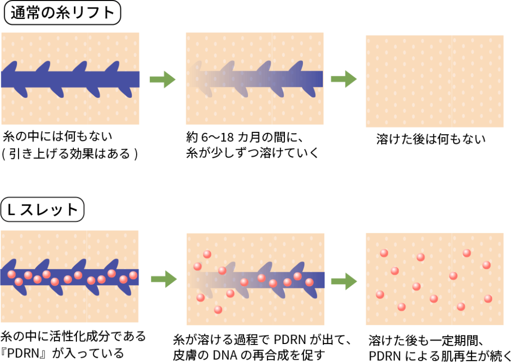 Lスレット