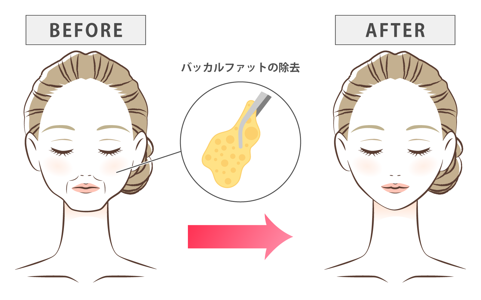 illustration_バッカルファット除去とは