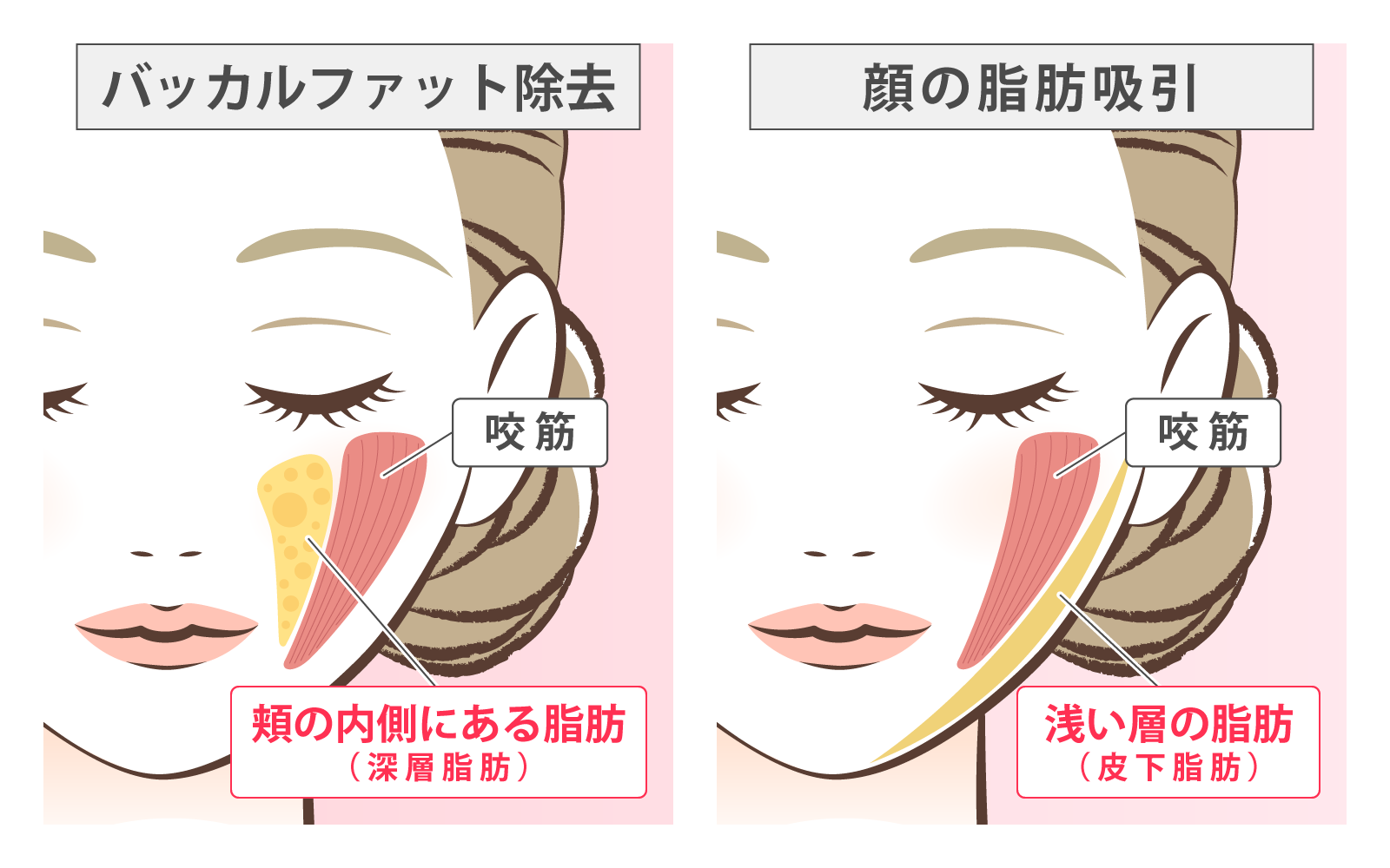 illustration_バッカルファット除去と脂肪吸引の違い