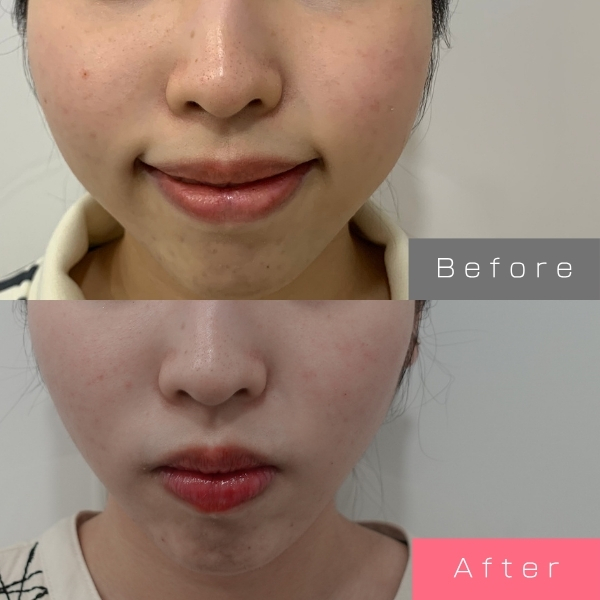 バッカルファット除去