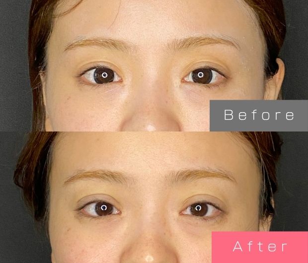 二重埋没法(自然癒着法)の症例写真