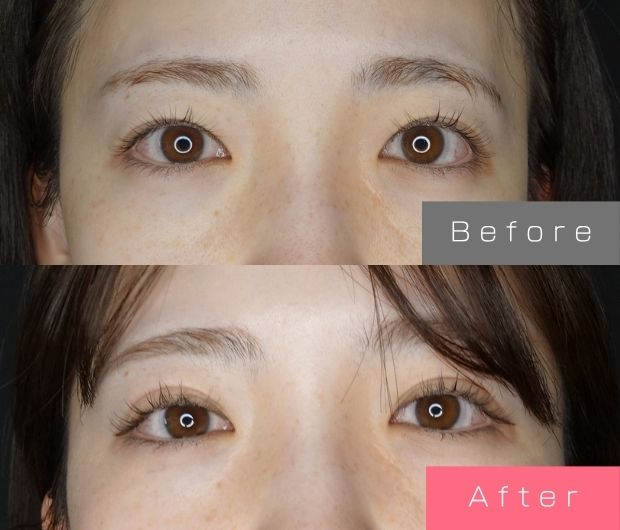 二重埋没法(自然癒着法)の症例写真