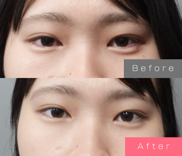 タレ目形成|涙袋ヒアルロン酸+タレ目ボトックス症例一覧 | L’amour clinic Tokyo(ラムールクリニック東京)渋谷院