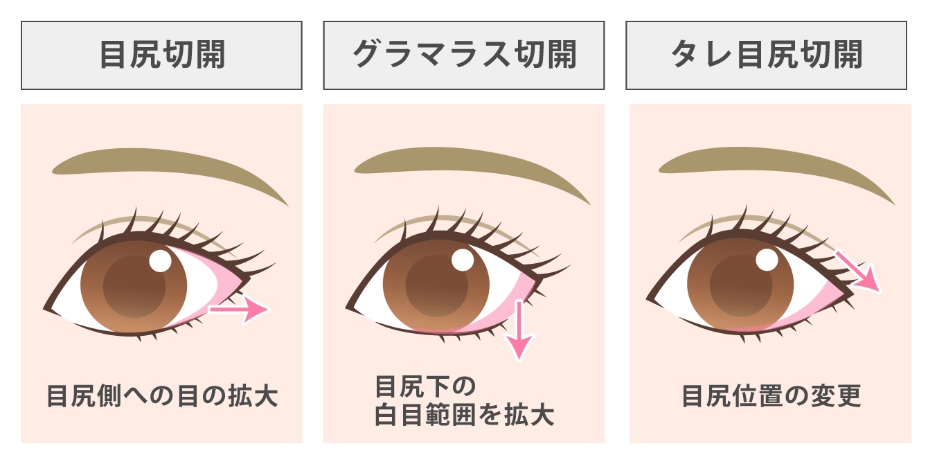 目尻切開とグラマラスライン形成・タレ目尻切開との違い