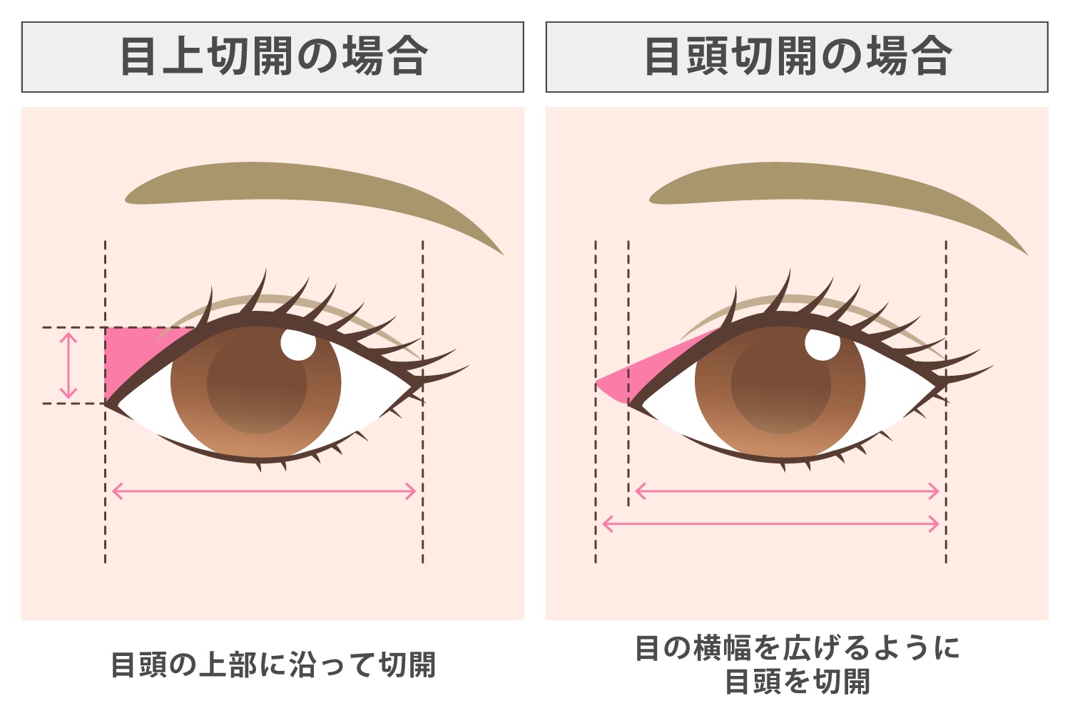 目上切開と目頭切開の違い