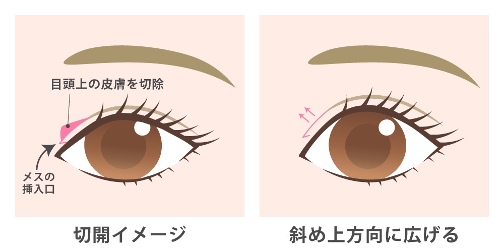 目上切開とは