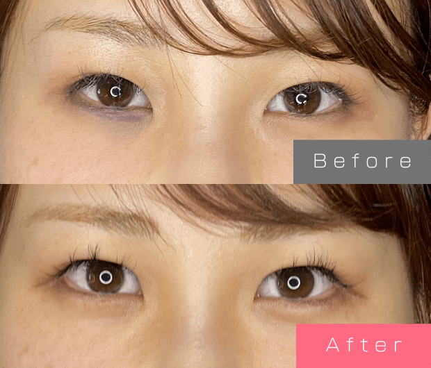 目上切開の症例一覧 | L’amour clinic Tokyo(ラムールクリニック東京)渋谷院