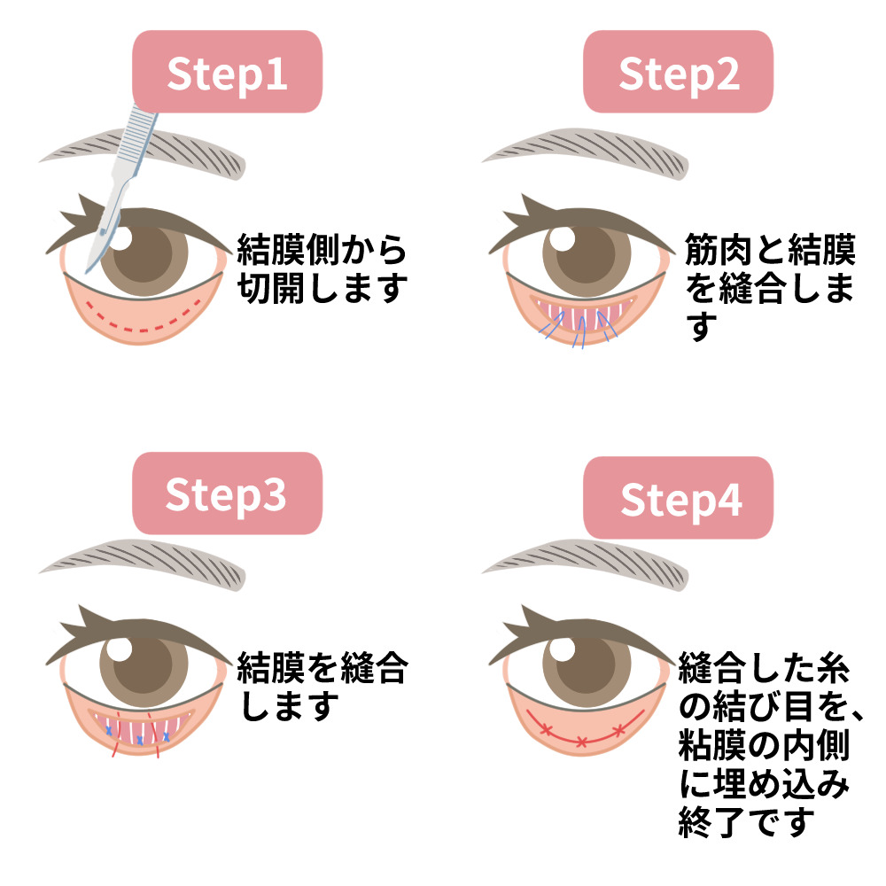 グラマラス切開(結膜側)