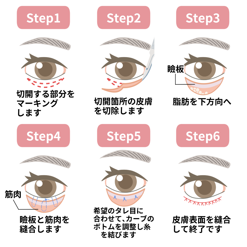 グラマラス切開(結膜側)