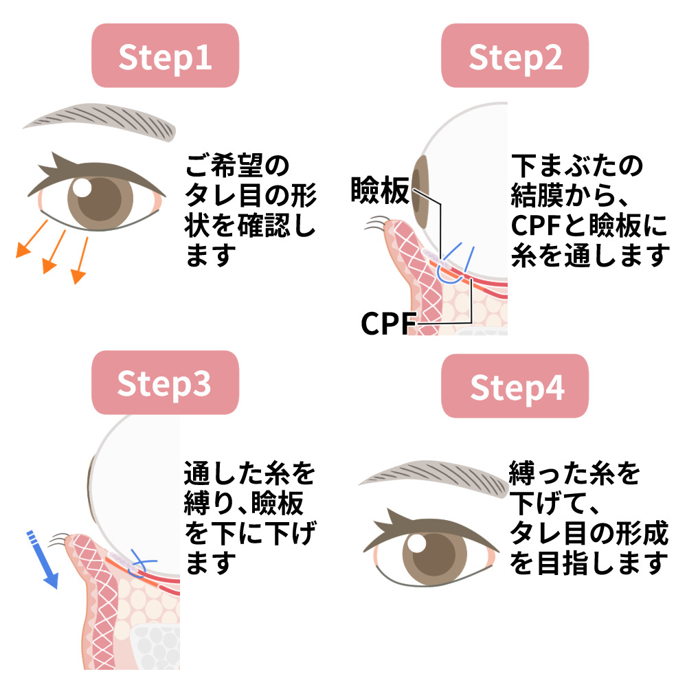 切らないタレ目形成(タッキング法)