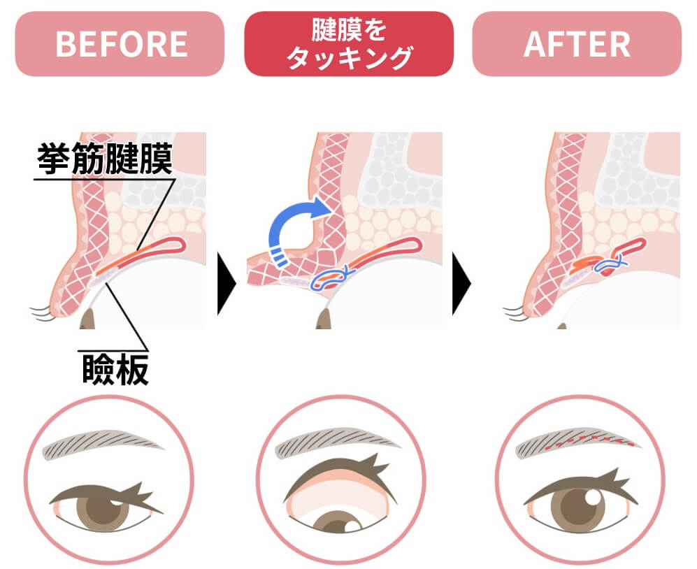 切らない眼瞼下垂
