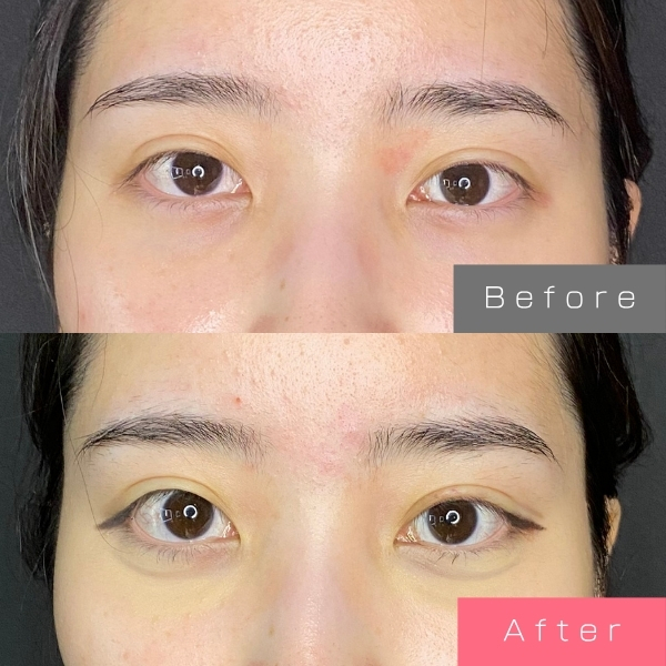 切らない眼瞼下垂の症例