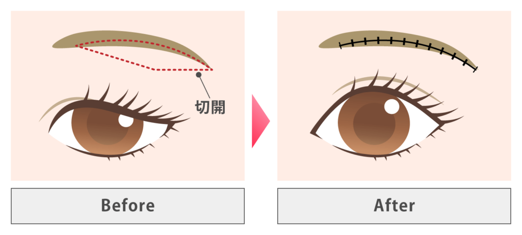 眉下切開の施術内容